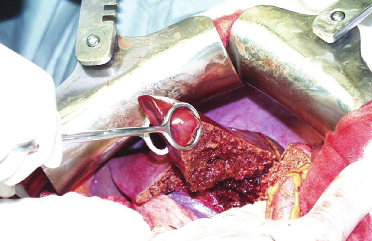 Resekce 4. jaterního segmentu
Fig. 2: Resection of liver segment IV