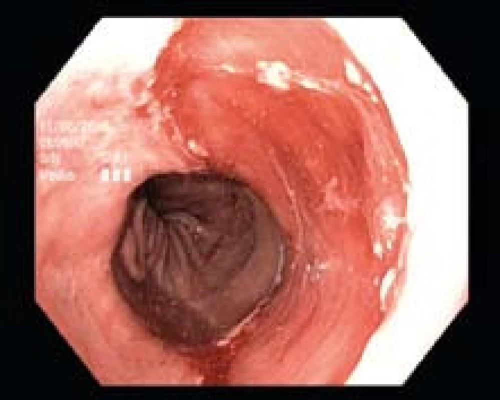 Stav po ER léze u téhož pacienta (z obr. 3), histologicky byl přítomný adenokarcinom. Léčba RFA bude následovat k eradikaci zbytkového segmentu BJ.
Fig. 4. Condition after lesion ER in the same patient (as in Fig. 3), histology identified the presence of adenocarcinoma. RFA treatment will follow to eradicate the BE residual segment.