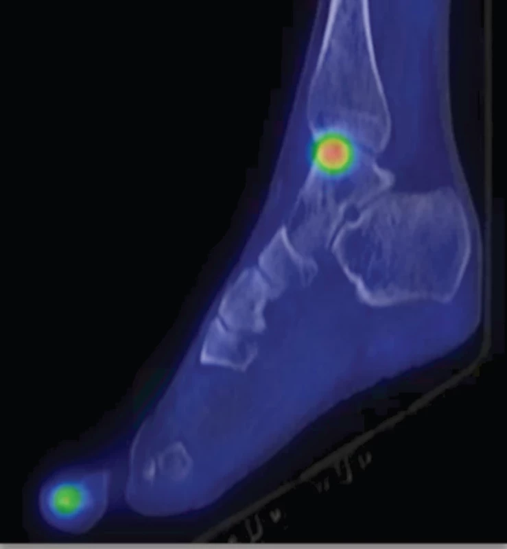 Fúze SPECT/CT v pozdní fázi v sagitálním řezu – akumulace RF v bezprostředním okolí defektu.