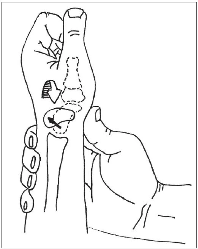 Watsonův test – schéma (volně podle GARCIA-ELIAS, M.: Carpal instability. In: GREEN, D.P., HOTCHKISS, R.N., PEDERSON, W.C., WOLFE, S.W.: Green's operative hand surgery, 5th edition. Philadelphia, Churchill Livingstone, 2005, s. 535-604.