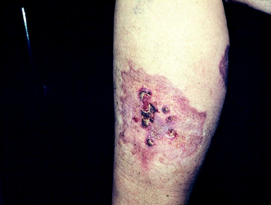 Necrobiosis lipoidica exulcerans.
