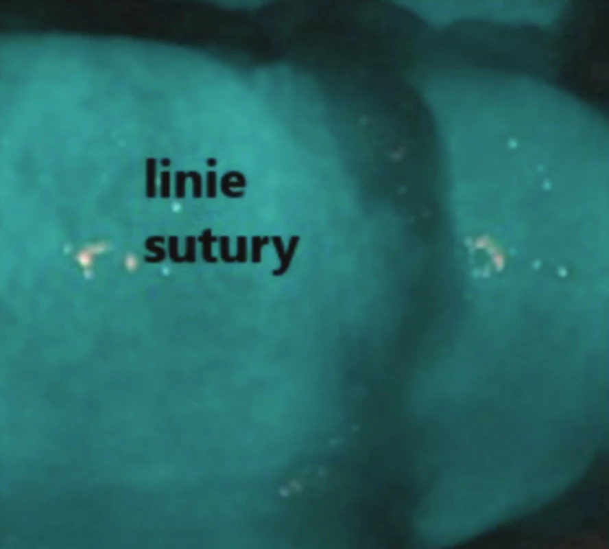 Fluorescenční angiografie ručně šité anastomózy s nižší dávkou podané ICG a vyšším kontrastem
Fig. 2: Fluorescence angiography of hand sewn anastomosis using reduced dose of ICG (high contrast)