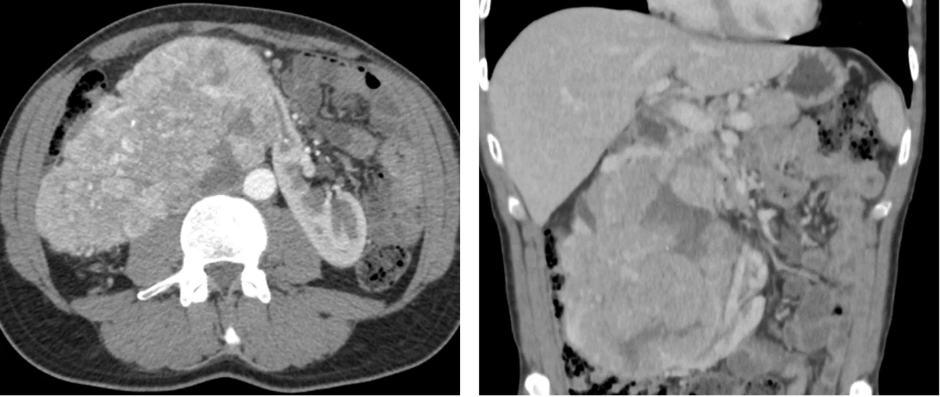  CT břicha s kontrastní látkou před zahájením terapie v transverzální a koronární projekci dokumentuje objemný tumor podkovovité ledviny velikosti 150 × 120 × 100 mm. Fig. 1. Contrast-enhanced abdominal CT in transverse and coronal planes prior to treatment initiation demonstrating a bulky tumour of the horseshoe kidney measuring 150 × 120 × 100 mm.