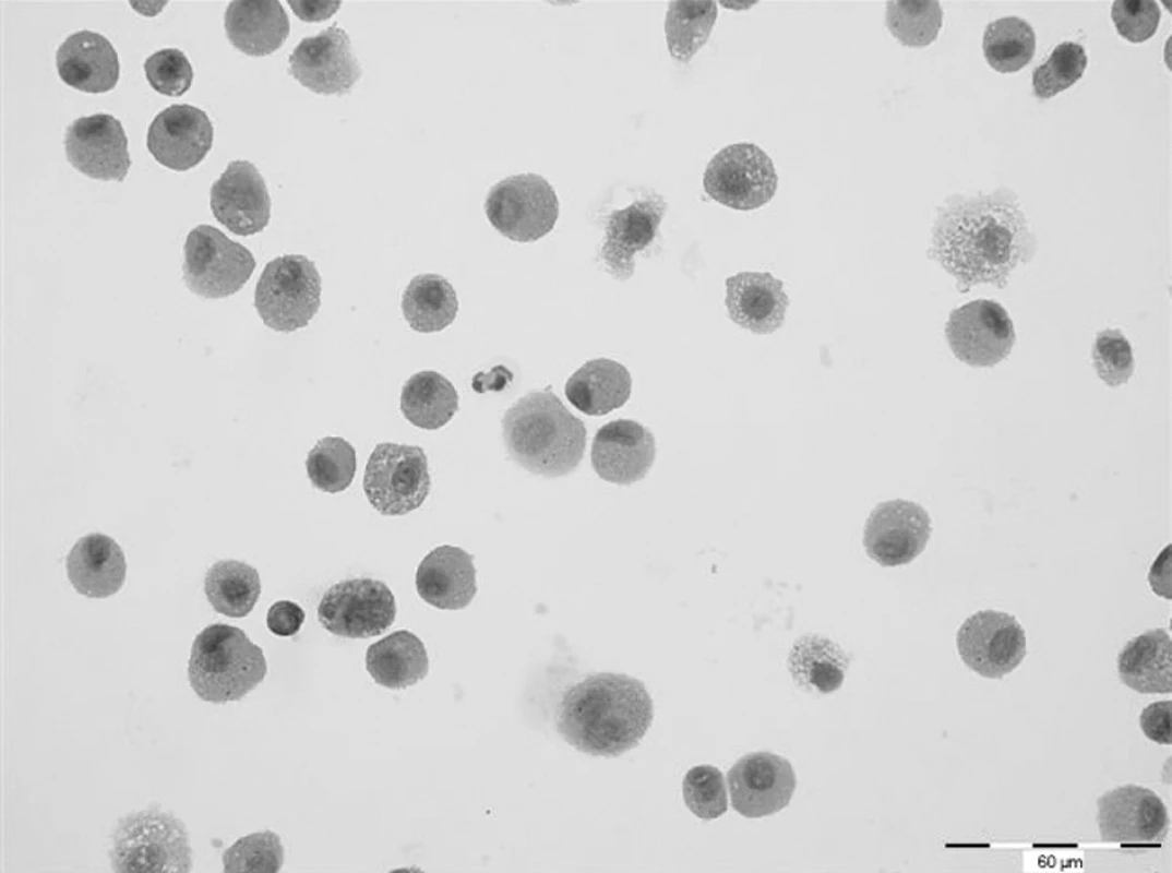 Cytologické vyšetření bronchoalveolárního aspirátu. Prakticky 100% zastoupení alveolárních siderofágů. Barvení haematoxylin-eosin. Zvětšeno 400x.