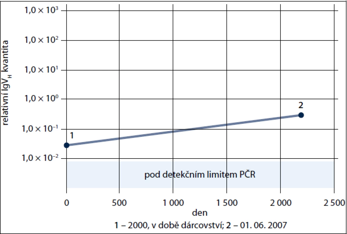 Relativní kvantifikace klonu B-CLL u dárce. 1. DNA izolovaná v době darování kostní dřeně – rok 2000, tj. 6 let před klinickou dg. B-CLL 2. DNA z roku 2007, tj. 2 roky po klinické dg. B-CLL se zbytkovou nemocí ve dřeni. Jasně prokázána přítomnost klonu 6 let před klinickým rozvojem B-CLL.