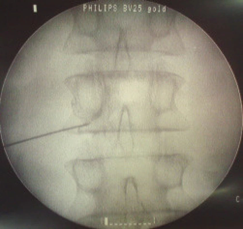 Pulzní RF-DRG L3 - rtg snímek v A-P projekci, kontrastní látka se šíří epidurálně.
