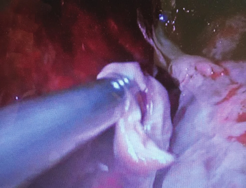 Uniportal sanace a dekortikace infikovaného posttraumatického hemotoraxu (pohled pomocí reverzní 30 stupňové optiky)
Fig. 1: Uniportal sanation and decortication of infected posttraumatic haemothorax (30-degree reversed optic view)