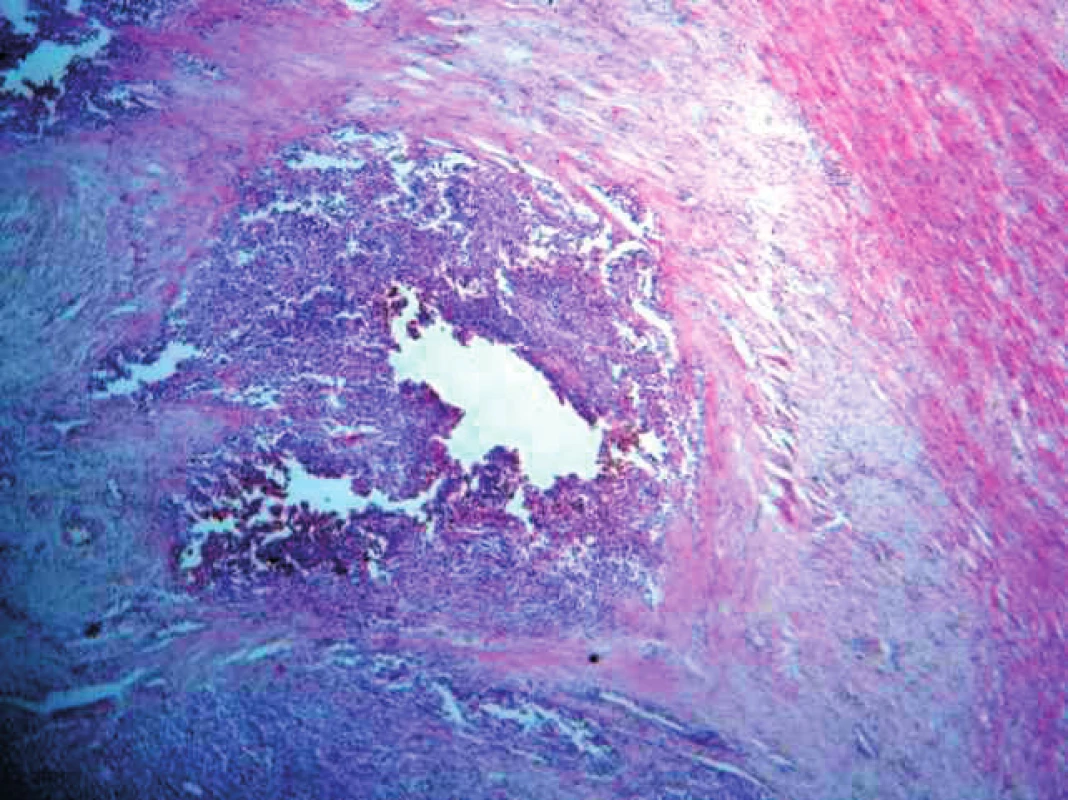 Histologický preparát myokardu: po okrajoch preparátu sú reziduálne (fragmentované) štruktúry svalových vlákien myokardu, centrálne metastázy malígneho melanómu