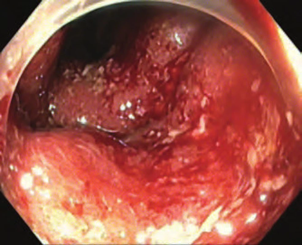 Endoskopie – aktivní proktokolitida (Mayo 3 skóre).
Fig. 1. Endoscopy – active proctocolitis (Mayo 3 score).