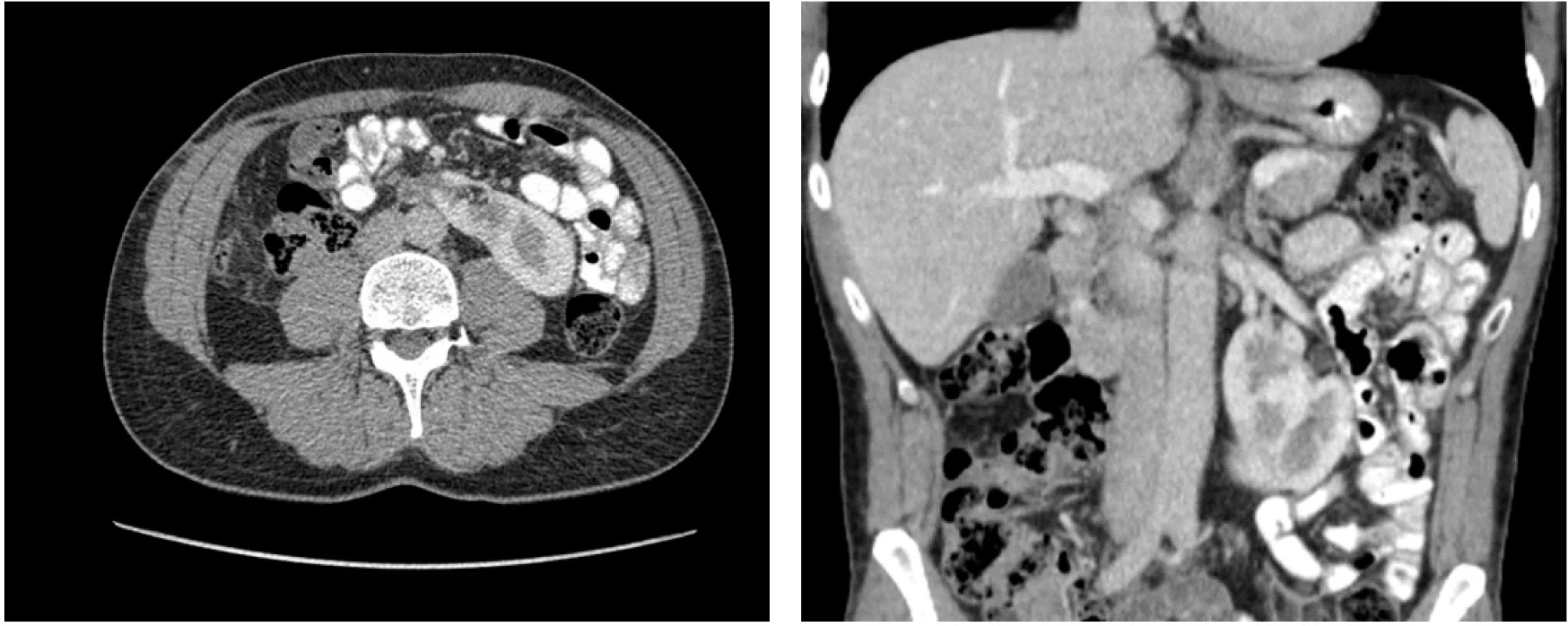 CT břicha s kontrastní látkou v transverzální a koronární projekci po radikální nefrektomii. Fig. 4. Contrast-enhanced abdominal CT in transverse and coronal planes following radical nephrectomy. 