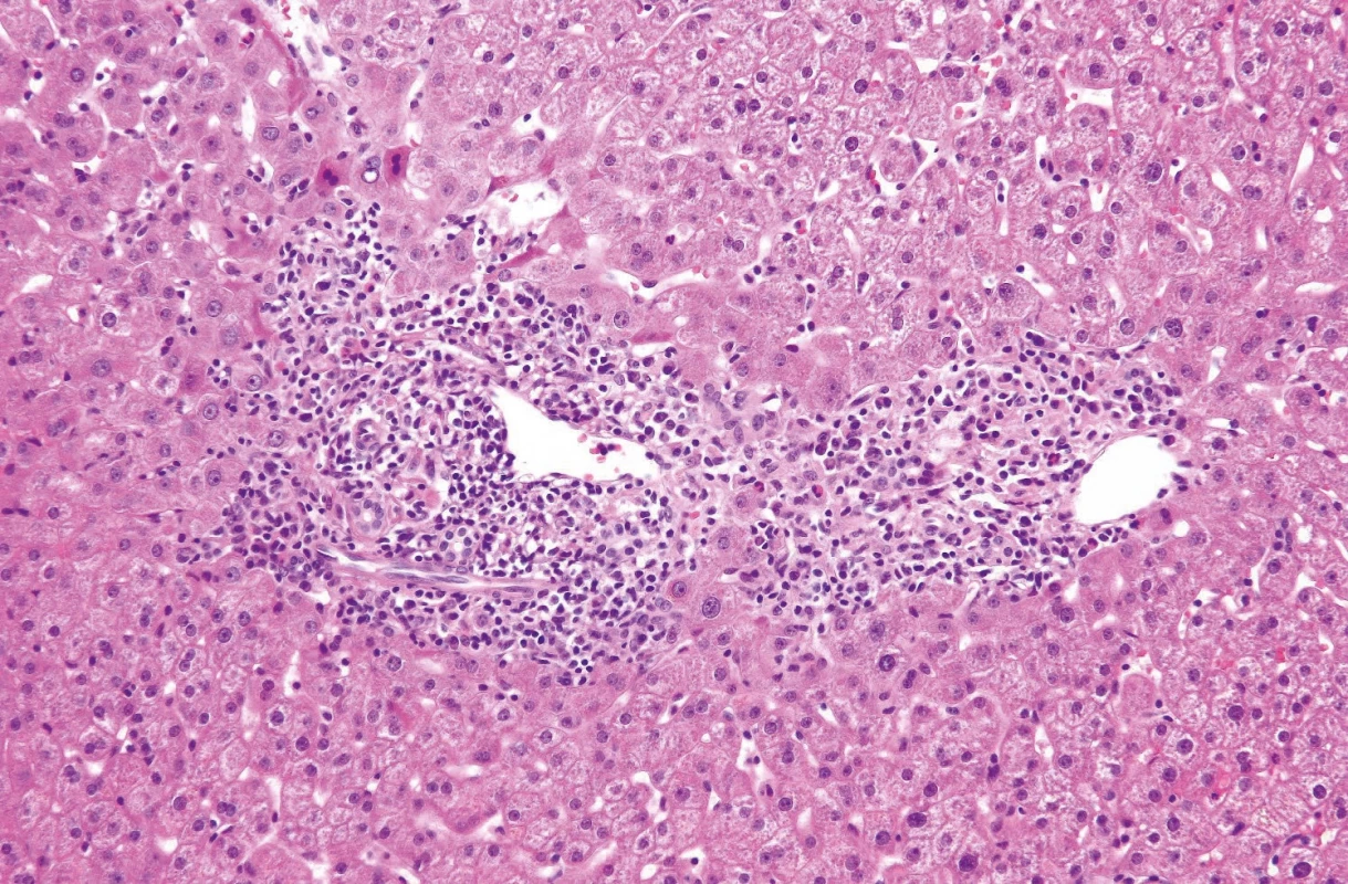 Akutní hepatitida s četnými plazmocyty a eozinofily se středně intenzivní portální (interface a významnou lobulární aktivitou a přemosťujícími nekrózami/centro-centrální, centro-portální), fokálně s krvácením. Známky regenerace jaterního parenchymu, bez fibrózy (interpretace doc. E. Sticová: při odpovídajících klinických a laboratorních parametrech (včetně vyloučení infekce je nález dobře kompatibilní s autoimunitní etiologií), morfologie typická pro AIH, dle simplifikovaných kritérií AIH (hematoxilin eozin zvětšení 200×)