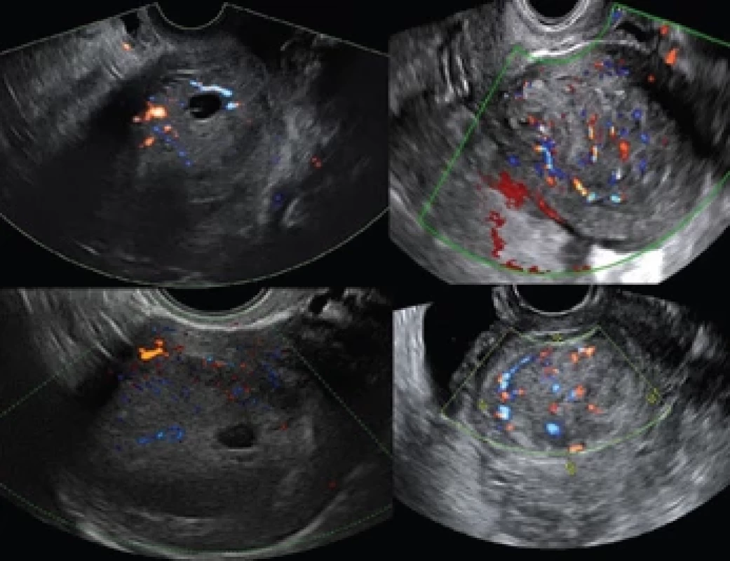 Ultrazvukové nálezy low-grade endometriálních stromálních sarkomů.