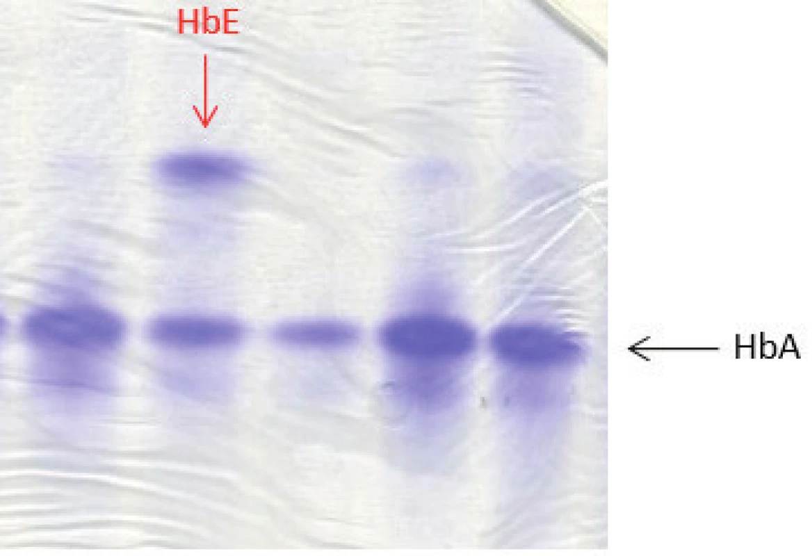 Proteinová elektroforéza (polyakrylamidový gel – PAGE) barvený Coomasie blue. Na obrázku zobrazené frakce hemoglobinového spektra HbA a HbE. Potvrzení nosičství alely pro HbE u našeho dětského pacienta bylo provedeno pomocí molekulárně genetického vyšetření (sekvenační analýzou). (Hemato-onkologická klinika, FN a LF Univerzity Palackého v Olomouci)
Fig. 4. Protein electrophoresis (polyacrylamide gel – PAGE) stained with Coomasie blue showing fractions HbA and HbE of the hemoglobin spectrum. HbE allele in a patient with HbE trait was confirmed by sequencing analysis.