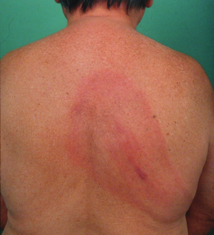 Erythema migrans na zádech