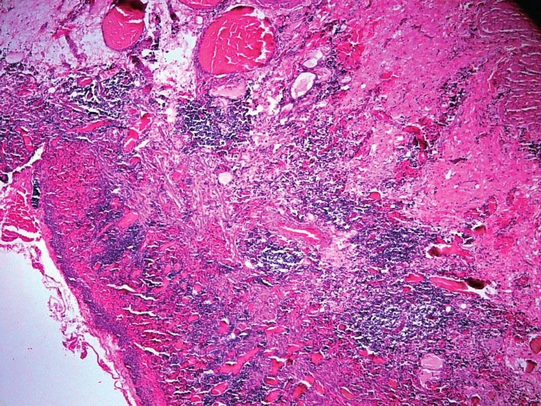 Histologický nález z místa ulcerace – v levém dolním rohu patrná ulcerace, na jejíž spodině je zánětlivá infiltrace. V hlubších vrstvách jsou zachyceny mnohočetné cévy, často dilatované (se svolením prim. MUDr. D. Kodetové, Ústav patologie a molekulární medicíny 2. LF UK a FN Motol).
Fig. 3. Histological findings at the place of ulceration. An ulceration is visible in the left bottom corner, and there is an inflammatory infiltration at the lower part of the ulceration. Multiple vessels, often dilated, can be distinguished in its deeper layers (with permission of prim. MUDr. D. Kodetová, Department of Pathology and Molecular Medicine, Charles University in Prague and Motol University Hospital).