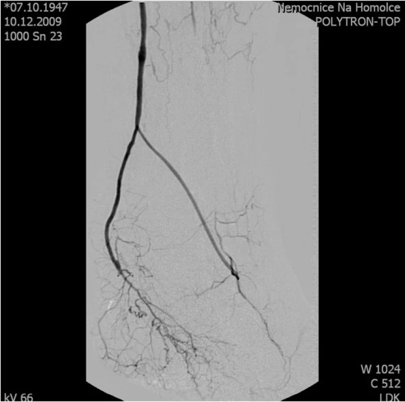 Pooperační angiografie větveného Y-graft pedálního bypassu