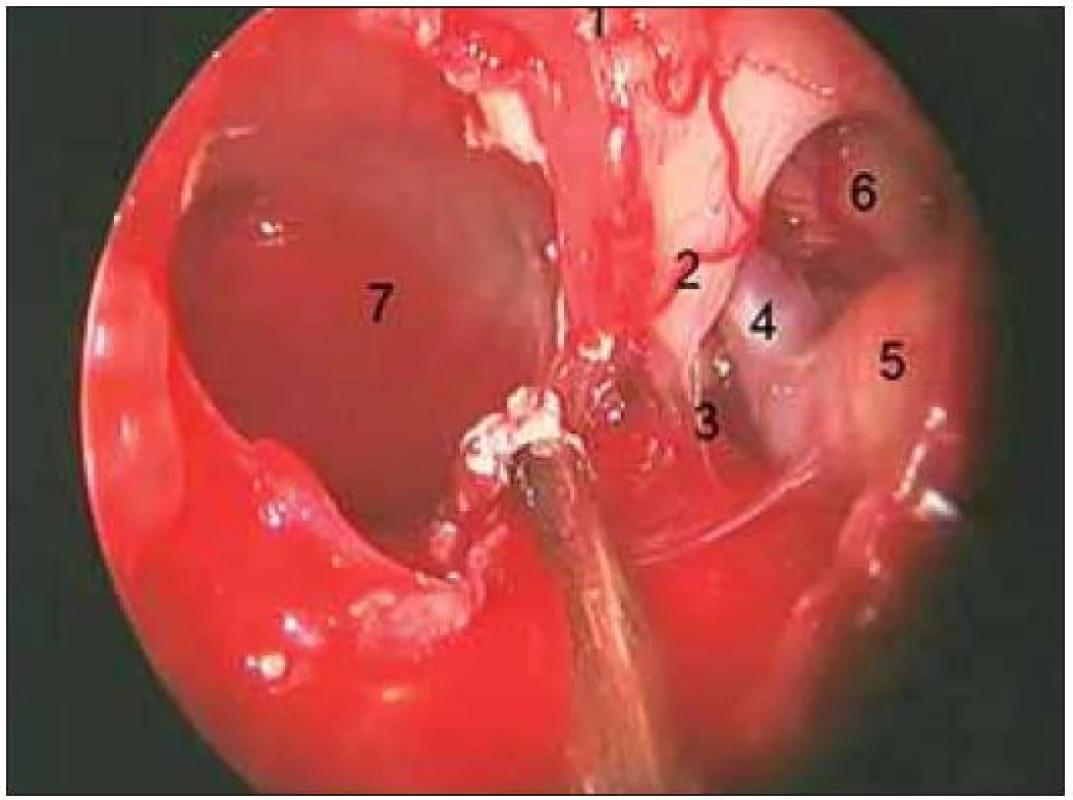 Peroperační foto – exstirpace kraniofaryngeomu.
1. chiasma, 2. optický trakt, 3. adheze pouzdra kraniofaryngeomu k optickému traktu 4. přední mozková artérie, 5. vnitřní karotida, 6. spodina čelního laloku, 7. dutina původního tumoru
