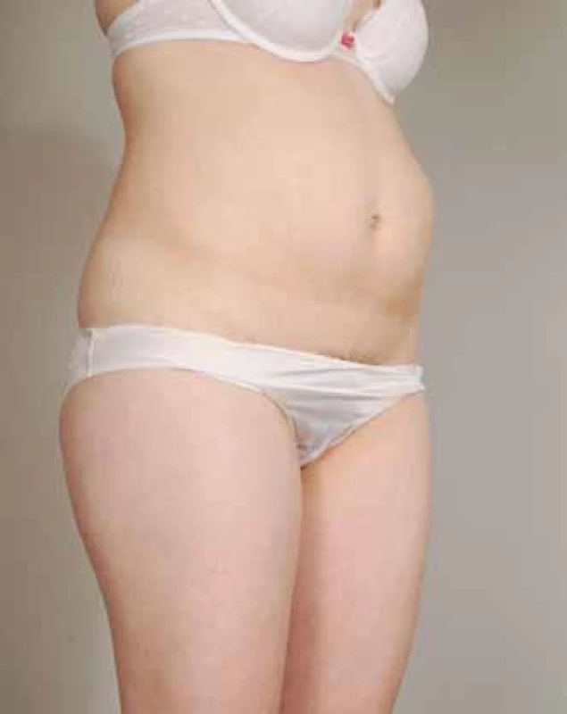 Progredující tumor v levém mezogastriu.