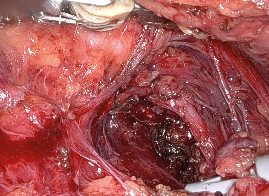 Dolní pól pravého laloku štítné žlázy s viditelnou dolní thyroideální tepnou Fig. 4: Lower pole of the right lobe of the thyroid gland with the inferior thyroid artery visible