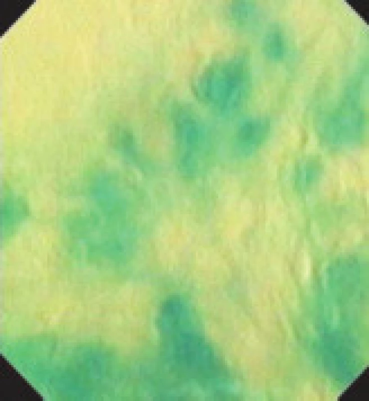 Endocytoskopie jícnu bez odstranění hlenu.