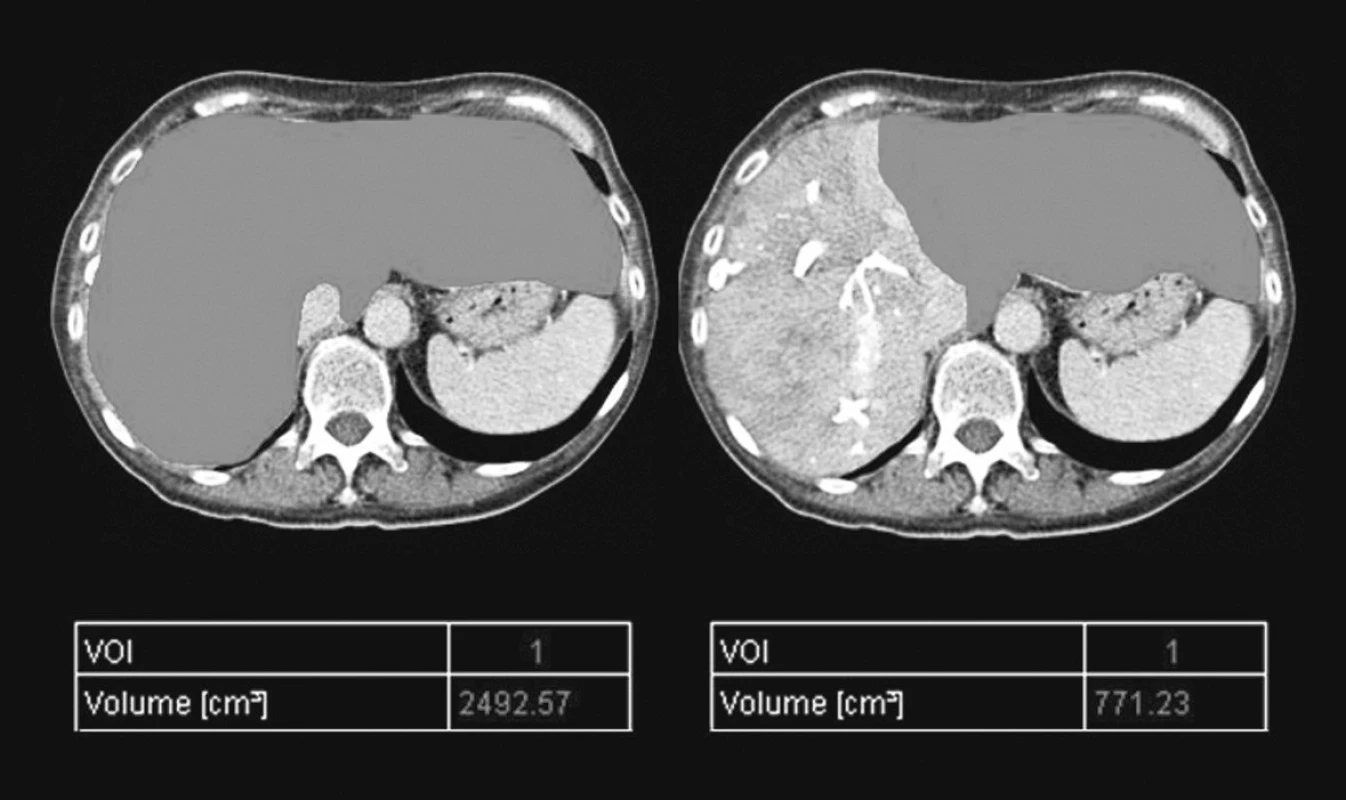 CT volumetrie po PVE
Pic. 3. CT volumetry following PVE