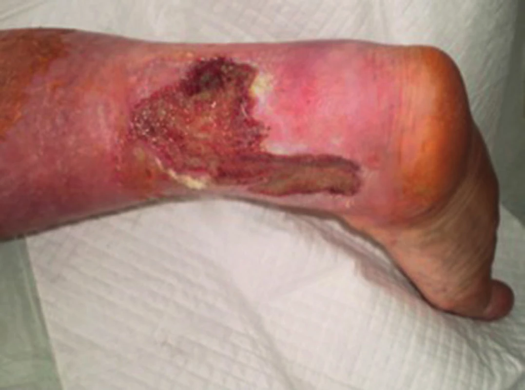 Pacient č. 1 − chronický kožní defekt po débridement a VAC terapii trvající 7 dnů
Fig. 4: Patient No. 1 − chronic wound after debridement and 7 days of VAC therapy