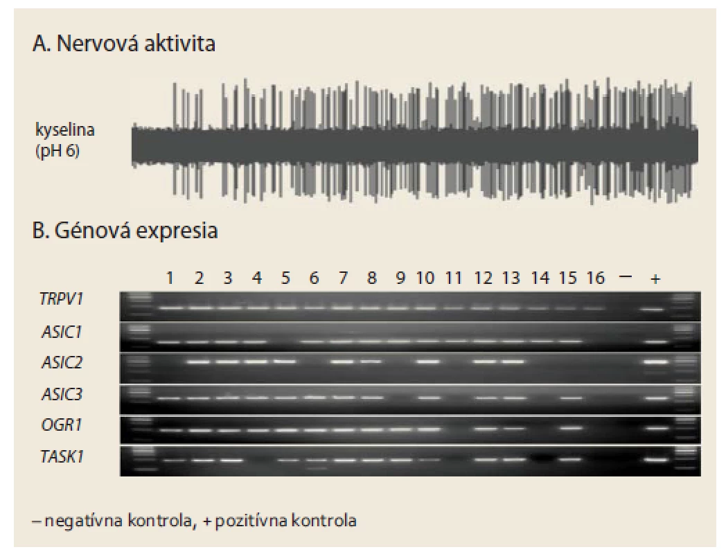 A. Pažerákové nervy sprostredkujúce pyrózu a bolesť(pažerákové nociceptory) sú relatívne vysoko citlivé na kyselinu a exprimujú receptory, ktoré sú v súlade s touto vysokou citlivosťou. Relatívne nízka acidita (pH 6) stačí na vyvolanie silnej aktivácie (výboja akčných potenciálov) v nociceptívnych nervových zakončeniach v pažeráku, keď sa slizničná bariéra experimentálne vylúči. Príklad pochádza zo spinálneho DRG nociceptora v pažeráku u morčaťa.
B. Pažerákové nociceptory exprimujú receptory, ktoré môžu navodiť nervovú aktiváciu už pri relatívne nízkej acidite (pH5,5–6,5), menovite podjednotky ASIC kanálov ASIC1, ASIC2 a ASIC3, receptor spriahnutý s G-proteínom reagujúci na kyselinu (proton-sensing G-protein coupled receptor) OGR1 a K2P (two- pore-domain) draslíkový kanál TASK1. Kapsaicínový receptor TRPV1 je marker nociceptívnych nervov v pažeráku. Príklad ukazuje analýzu 16 nociceptívnych DRG neurónov (jednotlivé neuróny sú číslované od 1 do 16) inervujúcich pažerák u morčaťa pomocou RT-PCR z individuálnych neurónov (single cell RT-PCR). Zostaveno dle [5].
Fig. 1. A. Esophageal nerves mediating pyresis and pain (esophageal nociceptors) are relatively highly acid-sensitive and express receptors that correspond to such high sensitivity. When the mucosal barrier is experimentally excluded, even relatively low acidity (pH 6) is sufficient to induce a strong activation (action potentials discharge) in nociceptive nerve endings in the esophagus. The example originates from the spinal DRG nociceptor in the esophagus of a guinea pig.
B. Esophageal nociceptors express receptors that can induce neural activation at relatively low acidity (pH 5.5–6.5); these in particular include ASIC channel subunits ASIC1, ASIC2 and ASIC3, receptor coupled with G-protein responding to acid (proton- sensing G-protein coupled receptor) OGR1 and K2P (two-pore-domain) potassium channel TASK1. Capsaicin receptor TRPV1 is a marker of nociceptive nerves in  the esophagus. The example shows analysis of 16 nociceptive DRG neurons (individual neurons are numbered 1–16) innervating the esophagus in a guinea pig, which was done using RT-PCR of the individual neurons (single cell RT-PCR). Compiled according to [5].