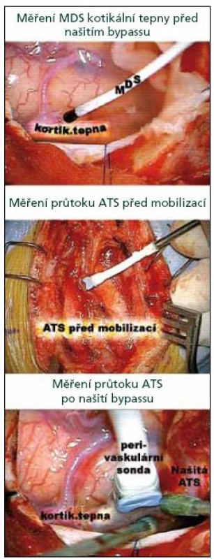 Ukázka 16MHz sondy pro MDS a 1,5MB sondy pro TTFM.