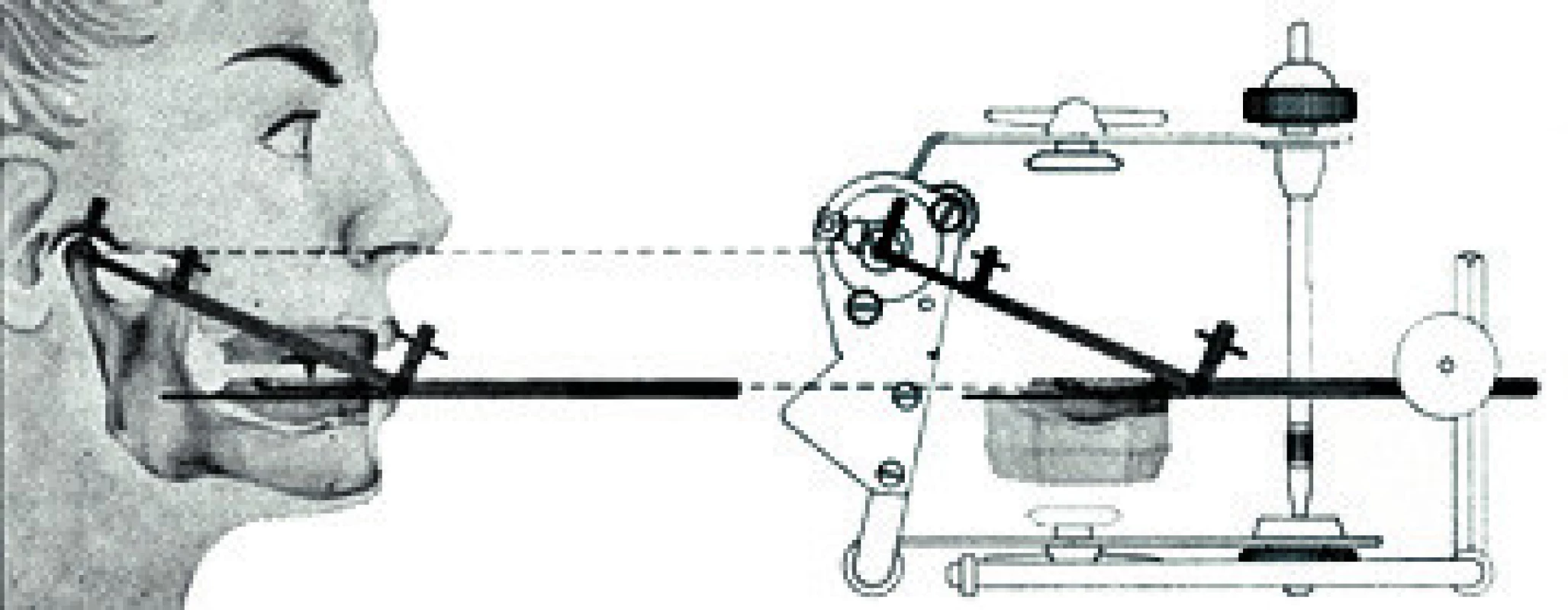 Schéma přenosu do semiadaptabilního artikulátoru Condylator (převzato z www.condylator.com)