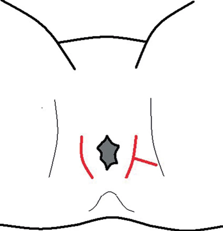Přístupy k periproktálním abscesům – červeně
Fig. 3: Approaches to periproctal abscesses – red line