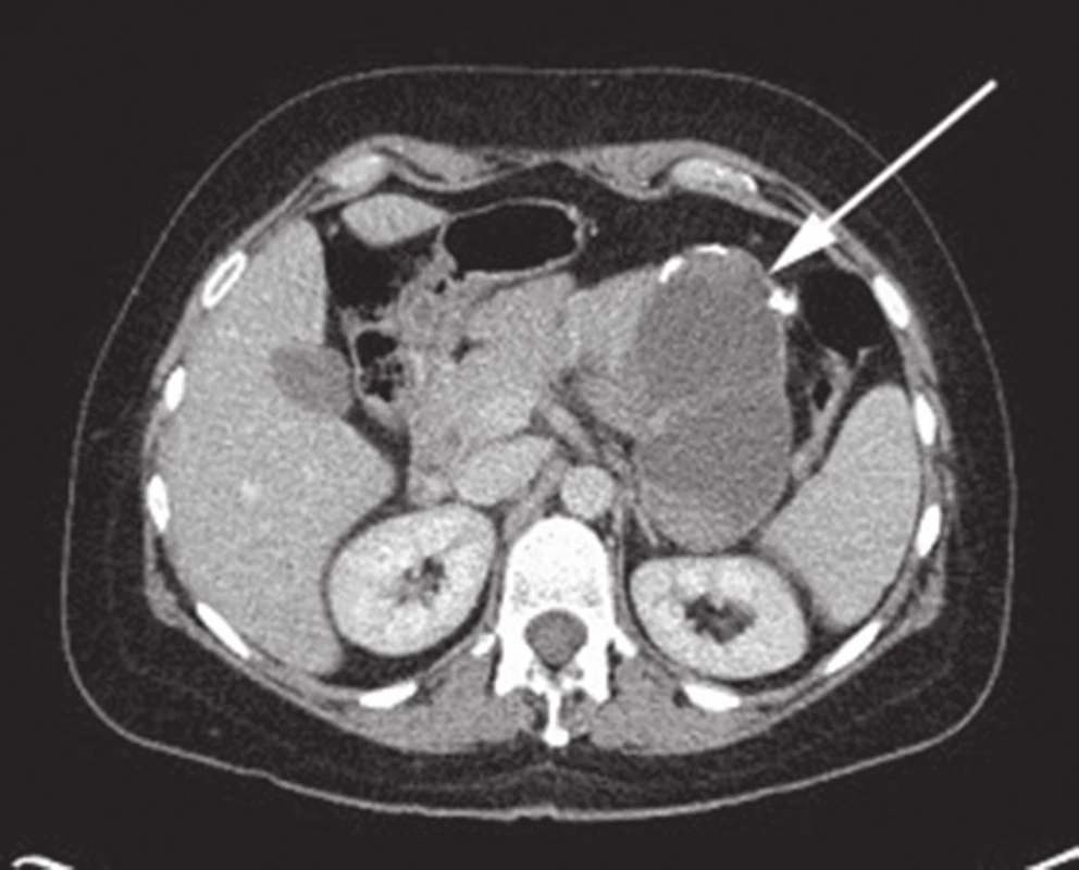 CT břicha s nálezem SPN v oblasti kaudy pankreatu
Fig. 1: Abdominal CT with the finding of SPN of the pancreatic tail