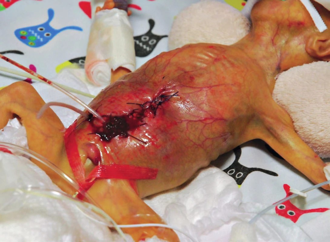 Extrémně nedonošený pacient (t. hm. 550 g), stav po druhé operační revizi
Patrné jsou střevní stomie, napjatá břišní stěna a krvácející dehiscence operační rány.