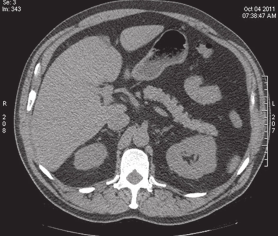 CT jater nativní − stejný pacient hypodensní okrsek v S4 patřící pseudolézi.
Fig. 2: Non-contrast CT scan of the liver – the same patient, hypo-dense area in segment S4 representing the pseudolesion.