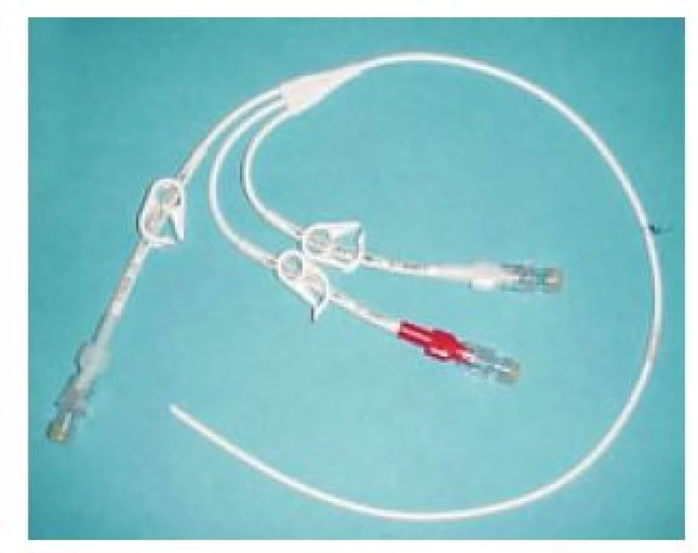 Hickmanov katéter.
Fig. 1. Hickman catheter.