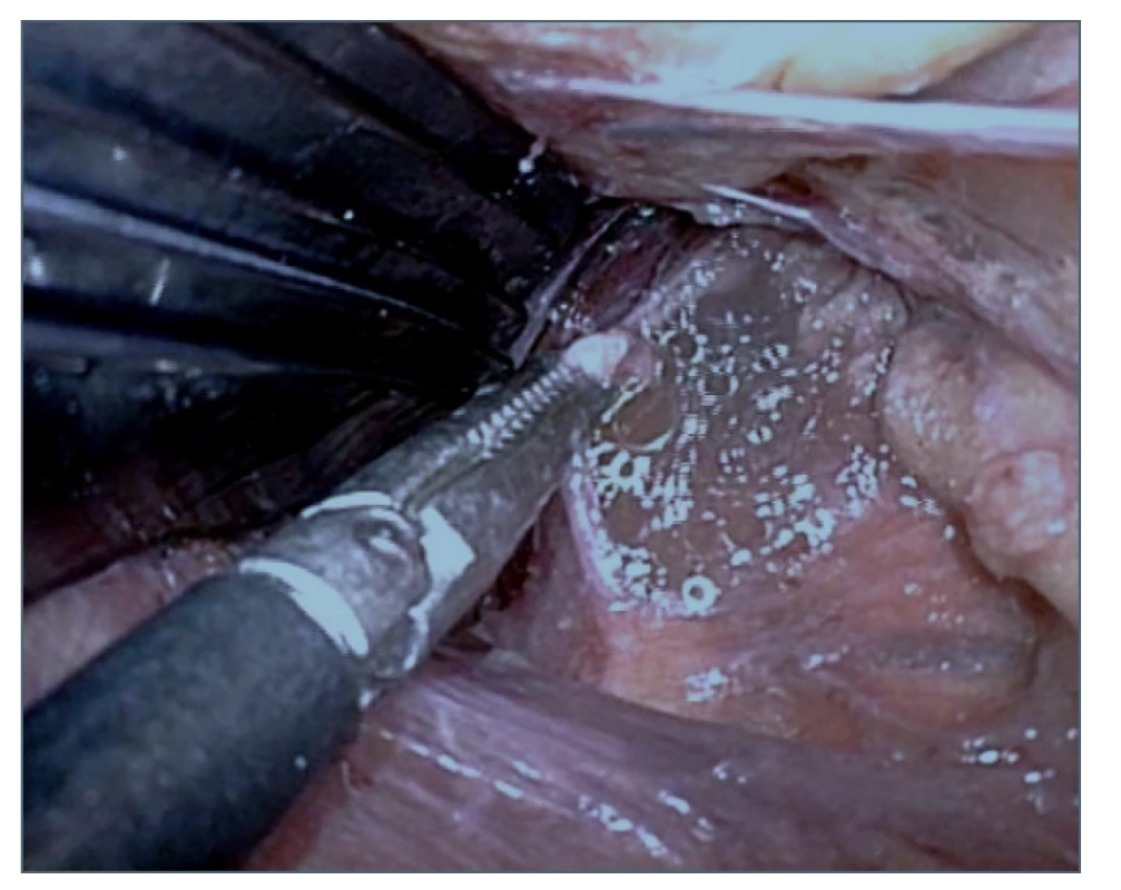 Výron chylu po identifikaci a nastřižení ductus
thoracicus<br>
Fig. 5. Chyle effusion after identification and cutting of
the thoracic duct