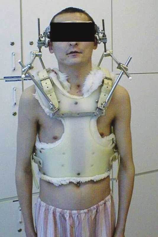 Naložený Halo vest
Fig. 5. A halo vest applied
