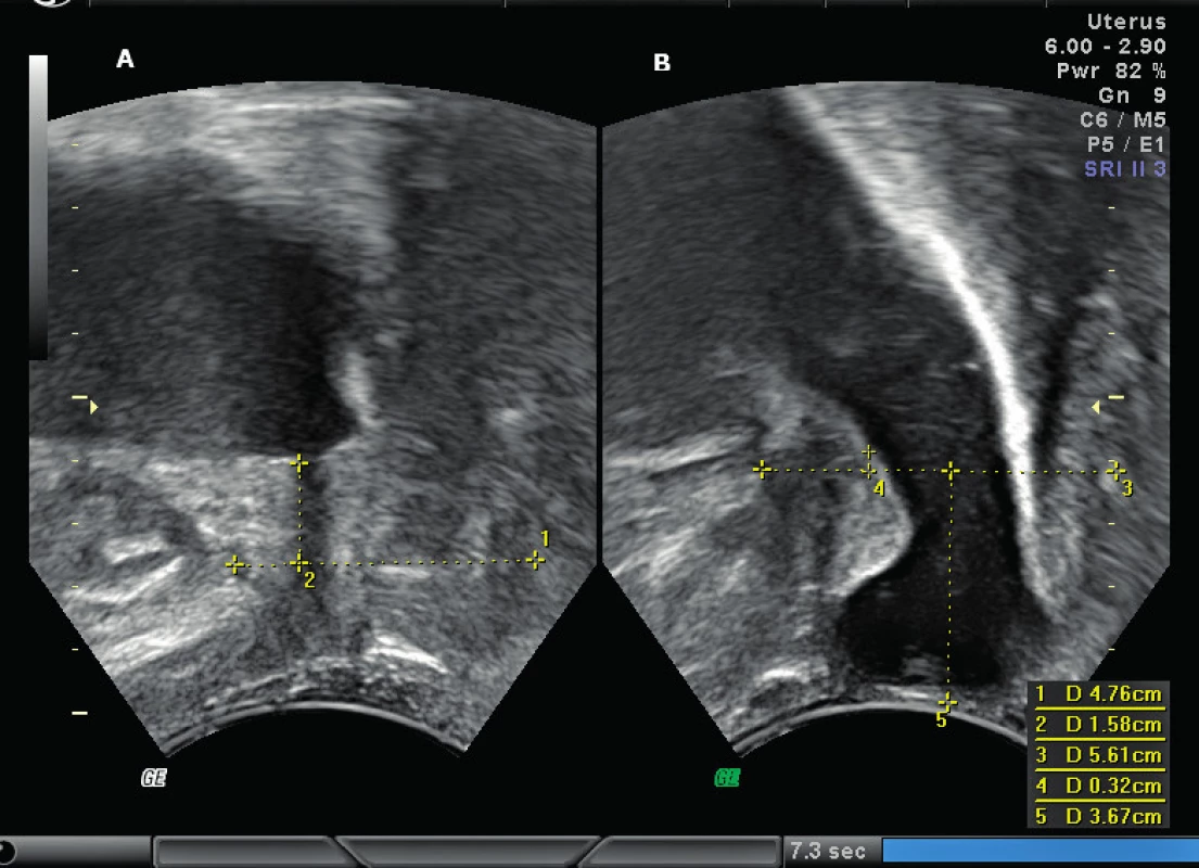 Cystokéla. A – UVJ v klidu, B – sestup UVJ o 1,26 cm, progrese cystokély 3,67 cm pod horizontálou