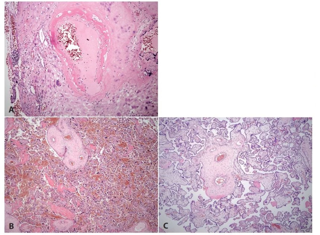 <b>Preeklampsie</b>. Placenta ze 33. týdne gravidity, akutní císařský řez pro těžkou preeklampsii, matka 24 let. <b>A</b>: Ateróza spirální arterie (HE, zvětš. 200x). <b>B</b>: Těžké kompenzatorní hypermaturační změny včetně poruchy architektoniky (HE, zvětš. 40x). <b>C</b>: Pro srovnání jiná placenta se zhruba přiměřenou architektoni- A kou klků (HE, zvětš. 40x).