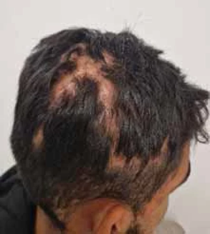 Perifoliculitis capitis abscendens et sufoidens. 