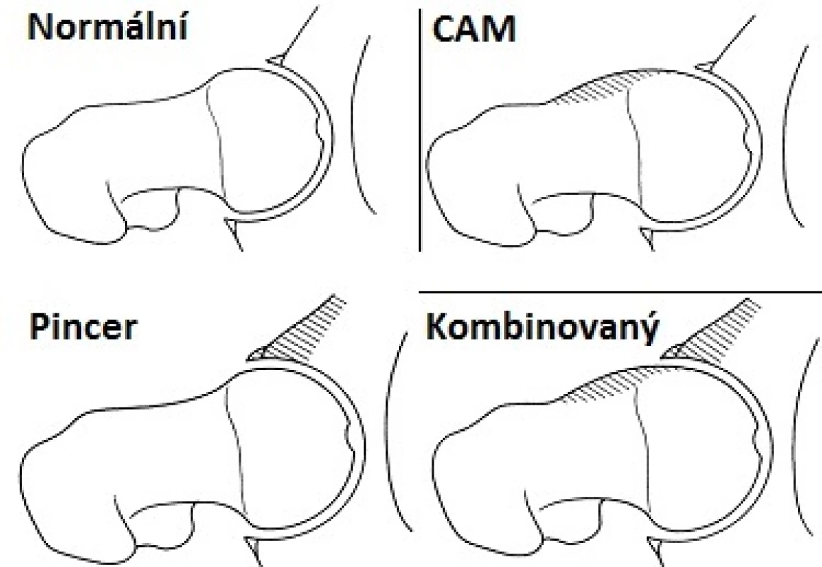 Základní typy FAI a porovnání s normálními anatomickými poměry kloubu