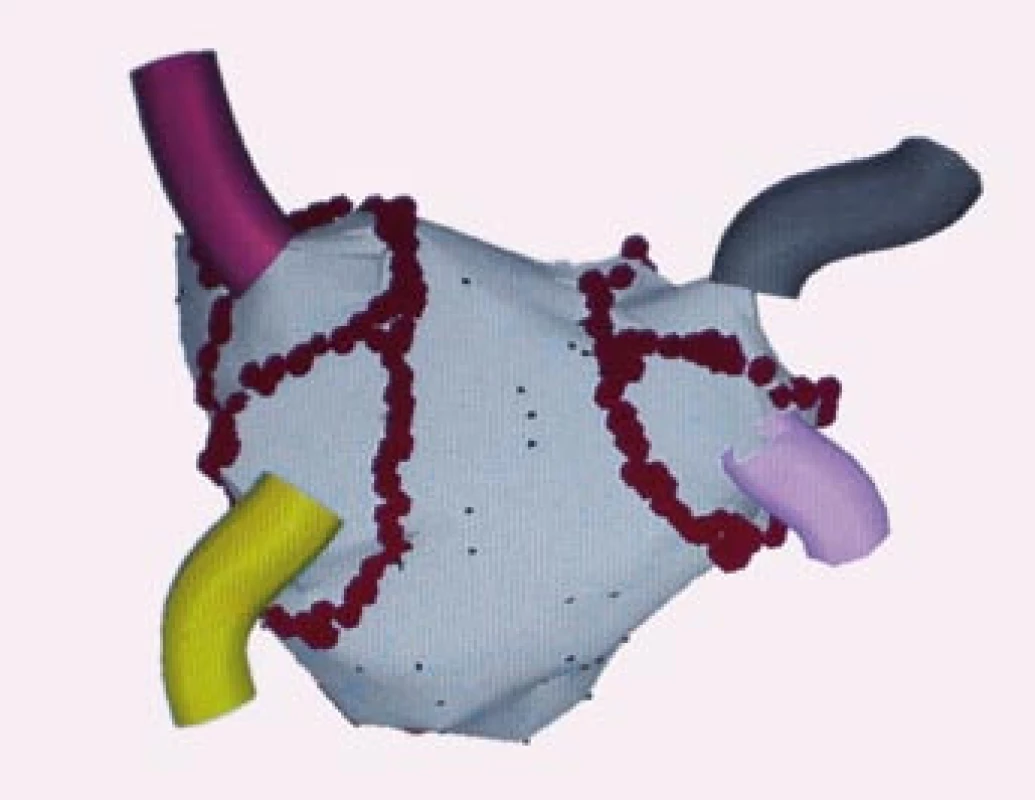 Trojrozměrné elektroanatomické mapování pomocí systému CARTO, pohled PA – posteroanteriorní.