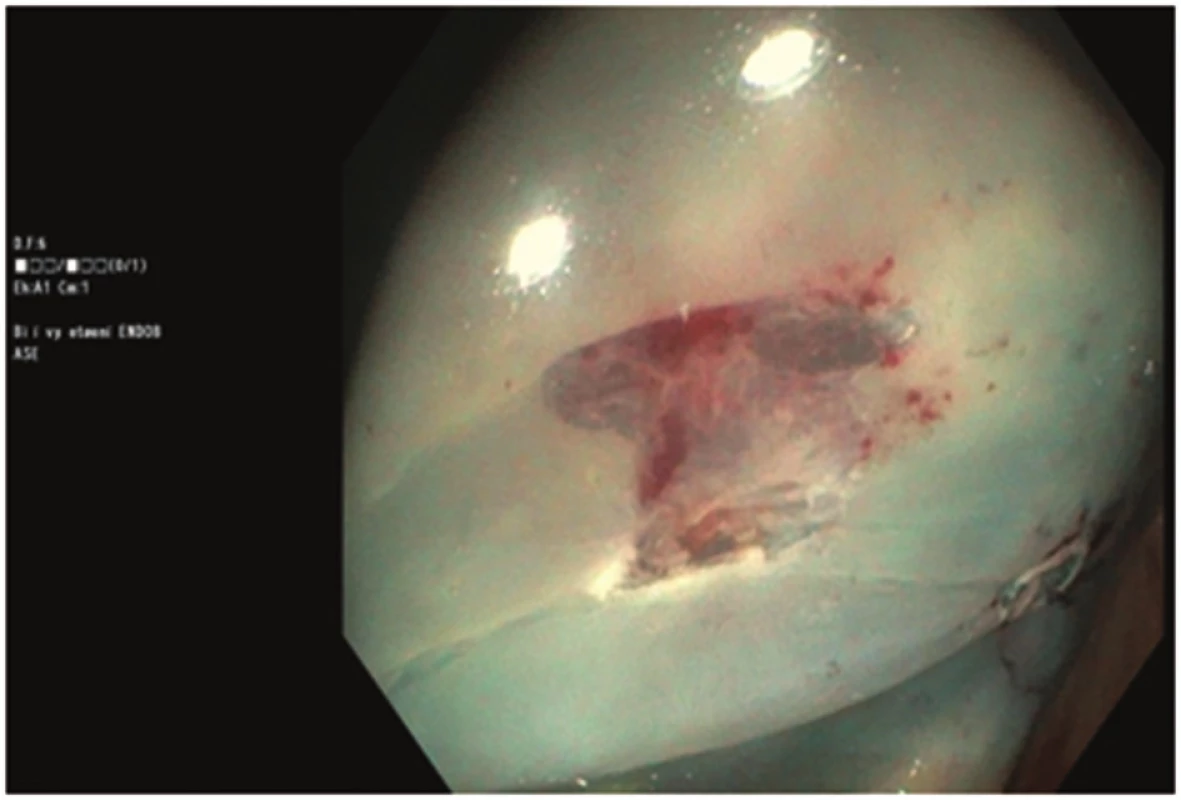Spodina po odstranění polypu velikosti 8 mm
Fig. 3: Base of the polyp sized 8 mm after polypectomy