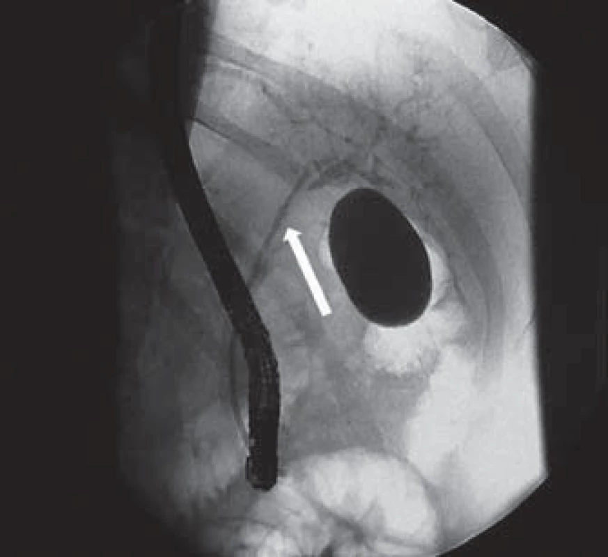 ERCP – zavedená biliární drenáž (7 Fr) do oblasti levého ductus hepaticus (šipka).
Fig. 3. ERCP – biliary drainage (7 Fr) inserted in the left hepatic duct (arrow).