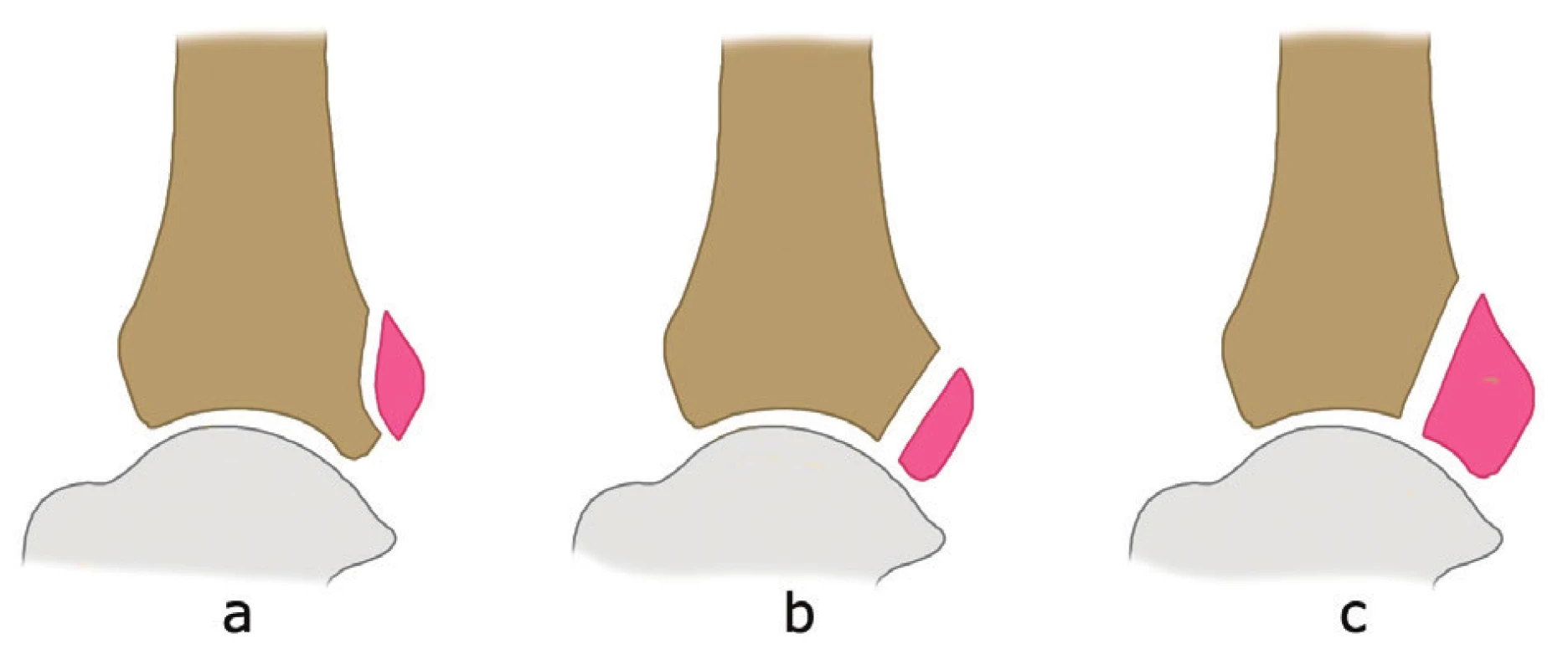 AO klasifikace z r. 1987
a – extraartikulární zlomenina, b – malý intraartikulární fragment, c – velký intraartikulární fragment. Volně podle [32].
Fig. 6: AO classification published in 1987
a – extraarticular fracture, b – small intraarticular fragment, c – large intraarticular fragment. Adapted from [32].