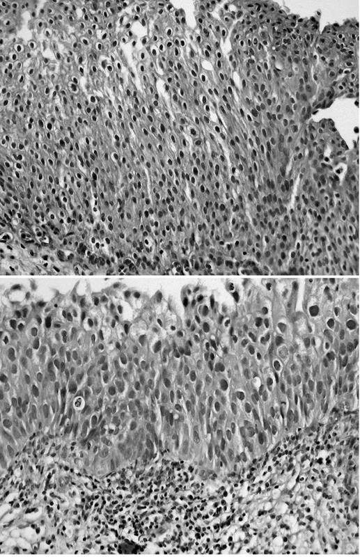 a, b. Plošná hyperplazie (a) v porovnání s monomorfním typem HG IUN (b) ve stejném zvětšení (HE, 200krát)
Přestože hyperplastický urotel má více vrstev, buňky jsou v něm pravidelné, nukleoplazmový poměr nízký. V dysplastickém urotelu i při monotónním vhledu jsou jádra zvětšená, vykazují mírnou anizokaryózu, neokrouhlost, různou denzitu chromatinu a vysoký nukleoplazmový poměr buněk, který vede k dotýkání se, místy až překrývání jader
