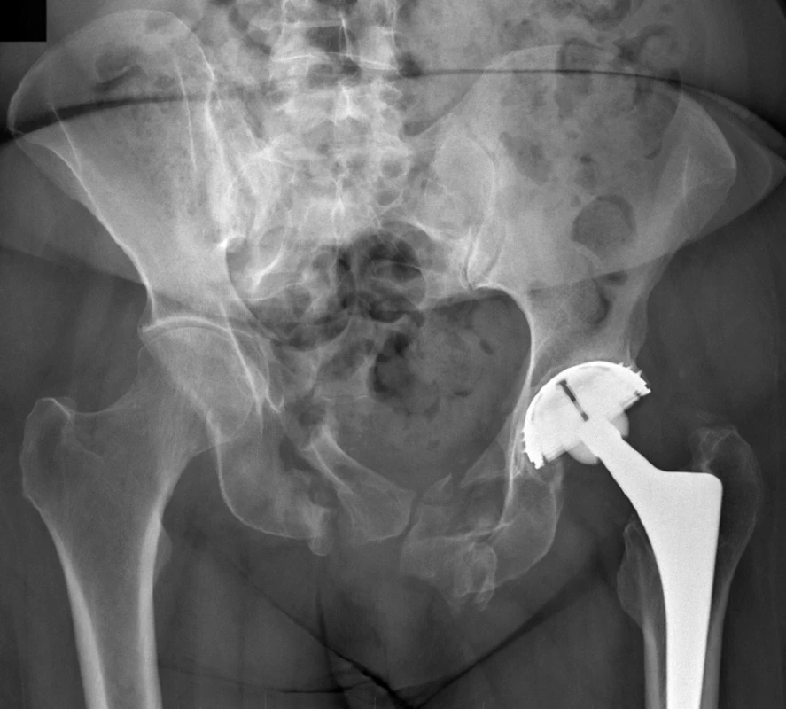 Pakloub pánve
Fig. 6: Non-union of the pelvis