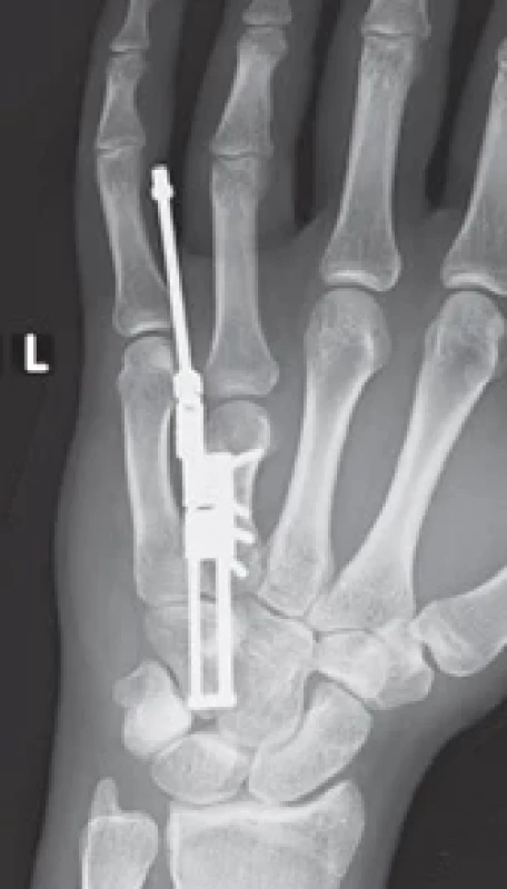 Intraoperative X-ray showing internal distractor placed after osteotomy.