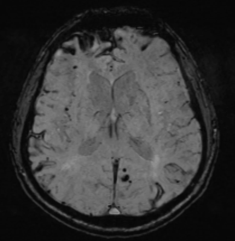 SWI – obraz amyloidózy: lemy hemosiderinu leptomeningeálně, intraaxiální depozita hemosiderinu predominantně v okcipitálních oblastech, šetření diencefalických struktur
