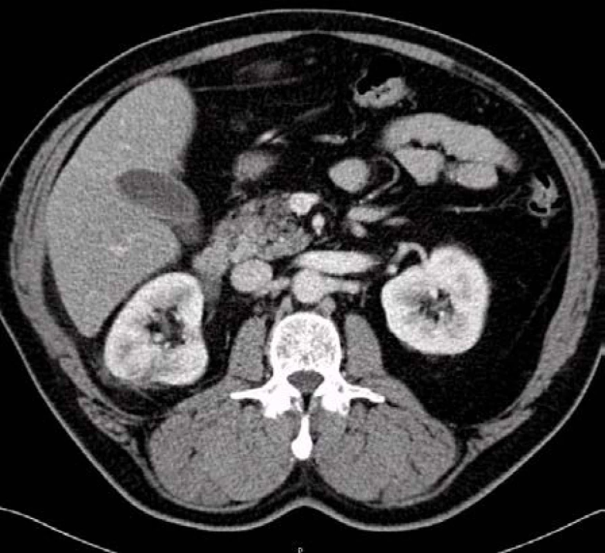 Stagingové CT šest měsíců po výkonu bez známek recidivy
Fig. 6. Staging CT six months after the treatment with no signs of relapse
