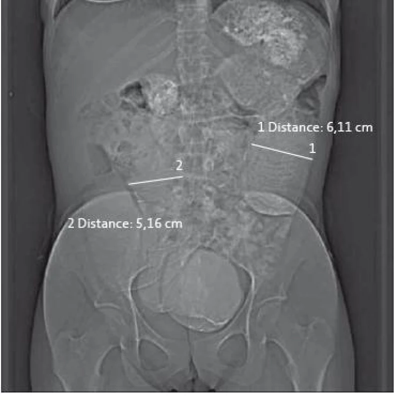 Ct-enteroklýza: vstupní toposcan zobrazující distenzi kliček jejuna.
Fig. 2. Computed tomography enterography: entry toposcan with dilatation of jejunum.